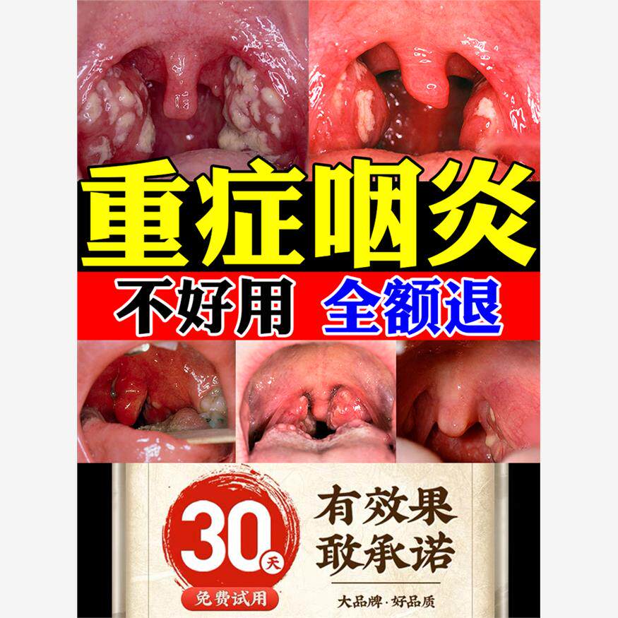 咽炎慢性咽炎除根咽喉炎治疗嗓子痰多异物感肿痛滤泡咳剂特效膏贴