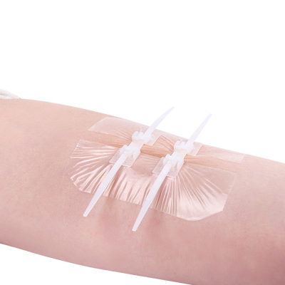 晨业减张贴疤痕医用皮肤减张器