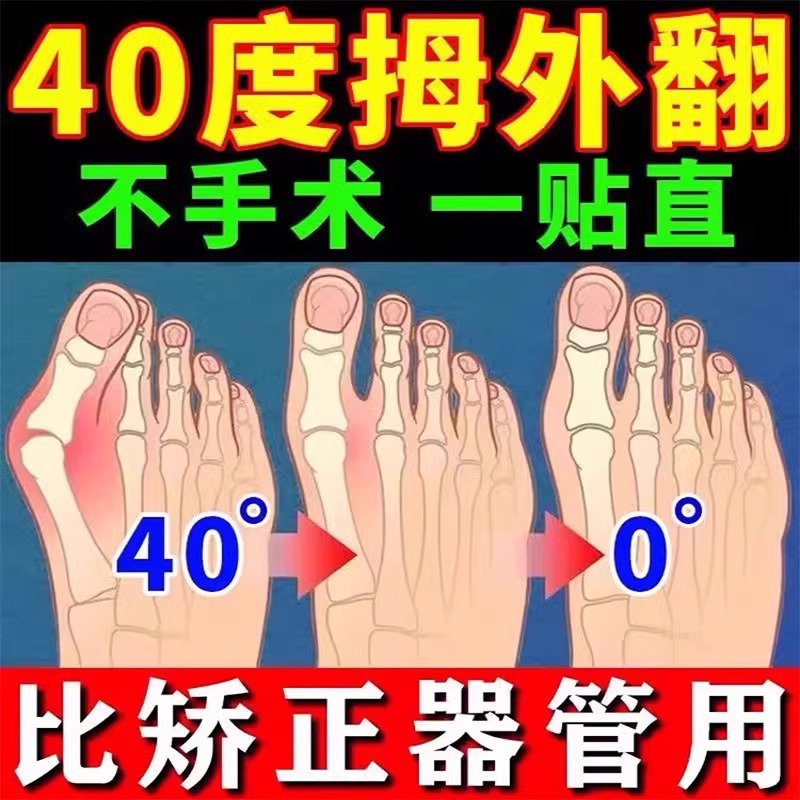 【一夜裉治】拇指外翻贴重症大脚骨外翻脚趾重叠防磨拇指外翻膏贴