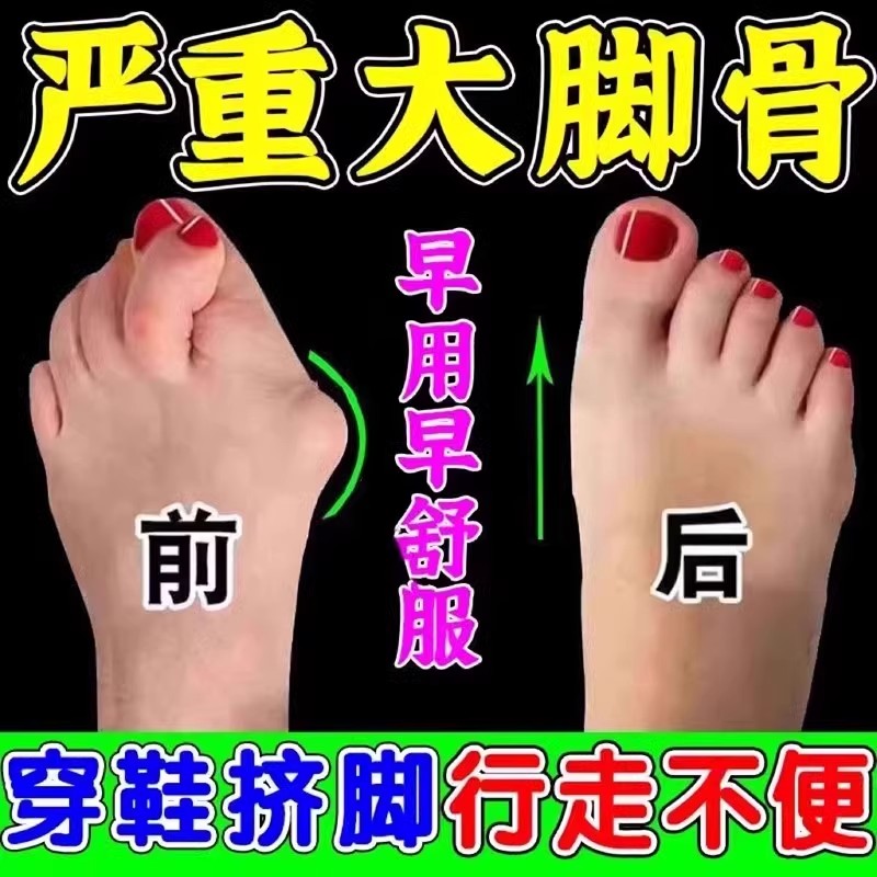 【一夜拔根】拇指外翻贴重症大脚骨外翻脚趾重叠防磨拇指外翻膏贴