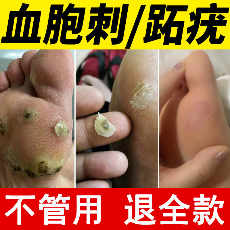 跖疣净鸦胆子刺猴膏去除祛止尤专用根肉刺血泡刺瘊子血胞刺根断