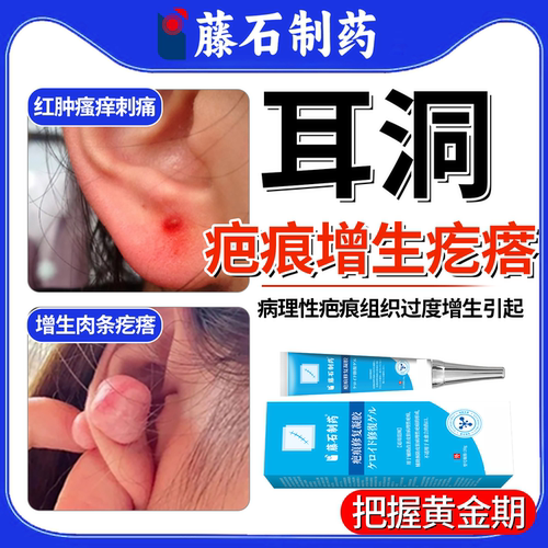 藤石制药耳洞增生疤痕疙瘩