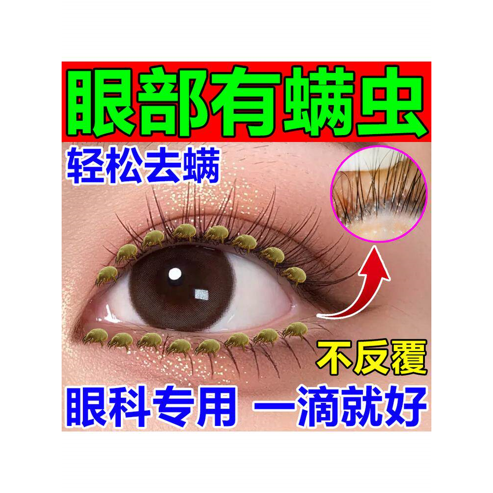 眼睛螨虫眼药水睫毛根部痒眼角眼皮眼睑发痒异物感清理杀菌滴眼液