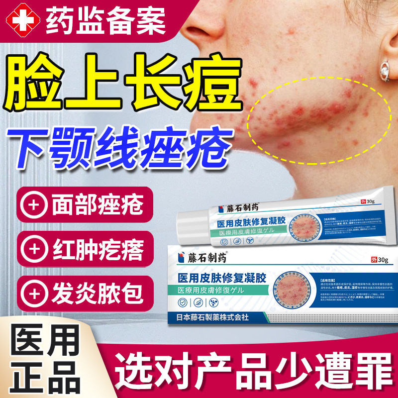 下颚线淋巴痘腮边痘专用下巴痤疮结节硬块痘痘面膜可搭配祛痘膏TU