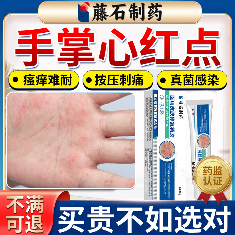 手掌手心红点瘙痒脱皮湿疹专用除湿止痒真菌感染手气汗疱疹水泡AA