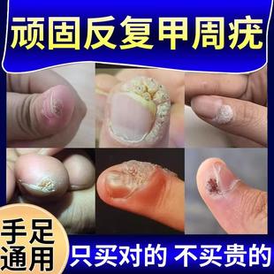 甲周疣甲下疣专用去儿童手指长疣寻常疣瘊子祛除去除硬皮神器HT