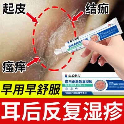 耳后起皮屑朵湿疹膏内外道