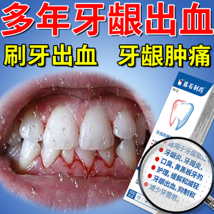 牙龈出血牙膏专用抗敏去黄美白祛渍牙周炎去口臭官方旗舰专用膏LZ