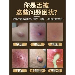 皮脂腺囊肿疖肿拔毒膏皮下粉瘤结节痘痘红肿火疖子乳膏HT