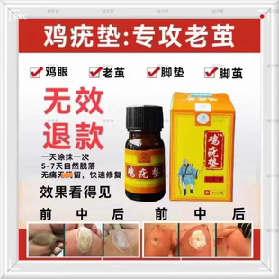 鸡疣垫鸡眼脚垫足小俞丫脚垫水手足厚茧老茧鸡眼瘊疣小丫微商同款