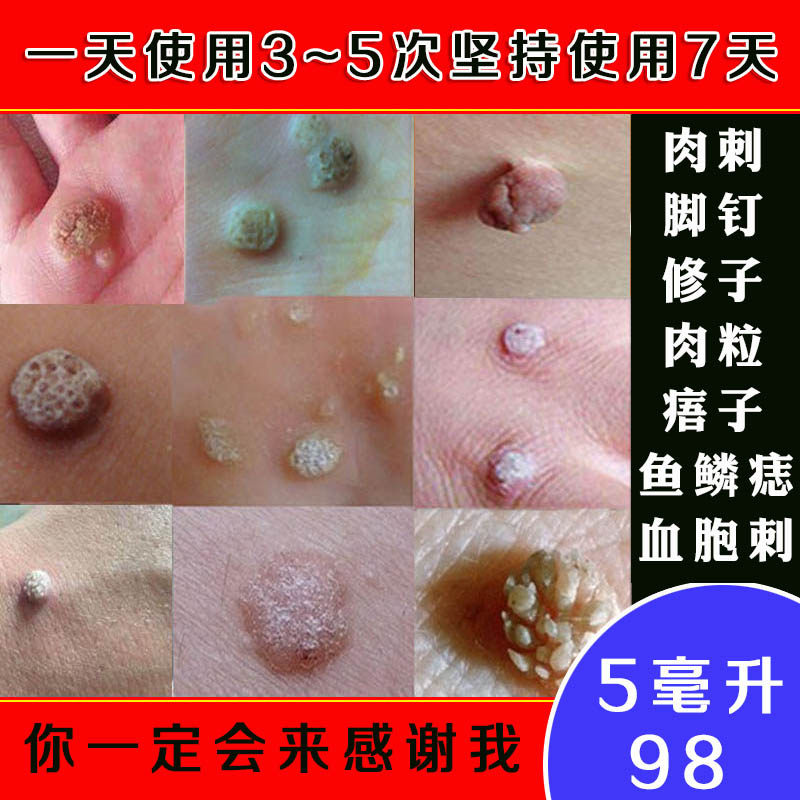 治鱼鳞痣专用脚肉刺去除膏瘊祛候子的药修子贴血胞刺去跖神器候子