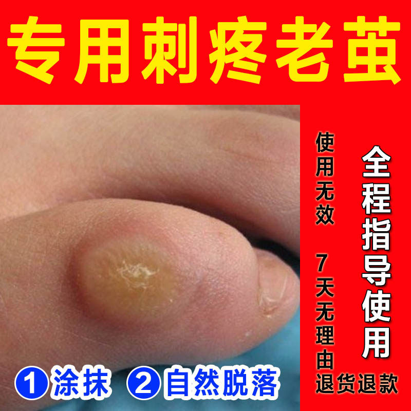 祛脚钉老茧膏垫死皮脚底板老茧脚上长硬疙瘩大小脚趾老茧专用肉刺