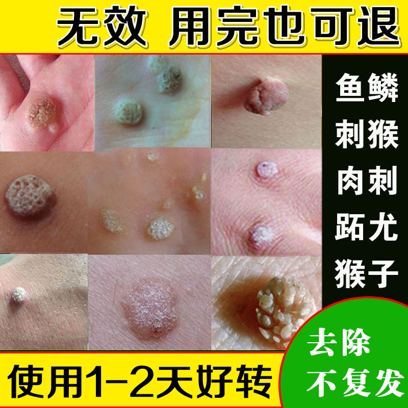 祛鱼鳞痣去除膏跖猴子