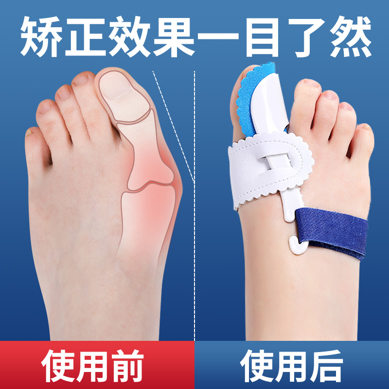 大脚趾拇指护理可穿鞋外翻矫正器