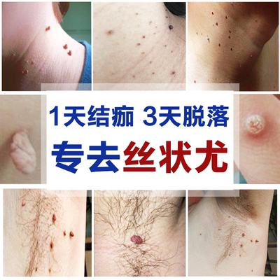 乳膏尖锐防复发足叶草鬼臼毒素酊