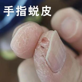 手脱皮严重脱皮专用真菌蜕皮干燥起皮药膏手指干裂剥脱性角质松懈