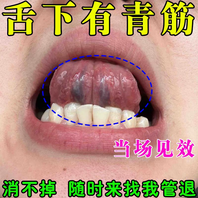 舌下青筋舌头下血管又黑又粗淤血疏通血管怒张严重舌下脉气血虚弱
