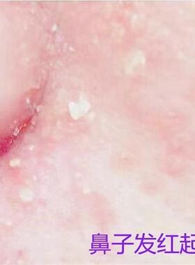 鼻子两侧起皮脱皮发红皮焱鼻翼两边泛红干燥修复长痘痘痒膏酒糟鼻
