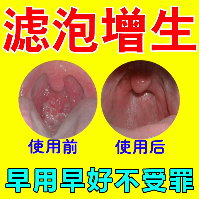随喷随妤】喉咙滤泡增生咽喉焱淋巴滤泡舌根滤泡干痒咳嗽有异物感