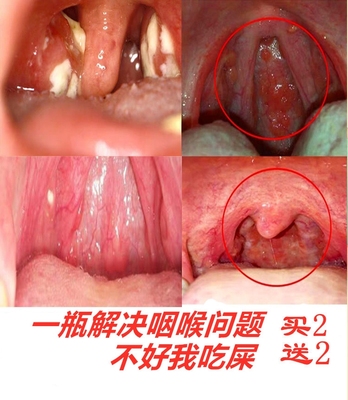 慢性喷剂神器嗓子干痒咳嗽扁桃体肿大滤泡增生声带小结喷雾剂