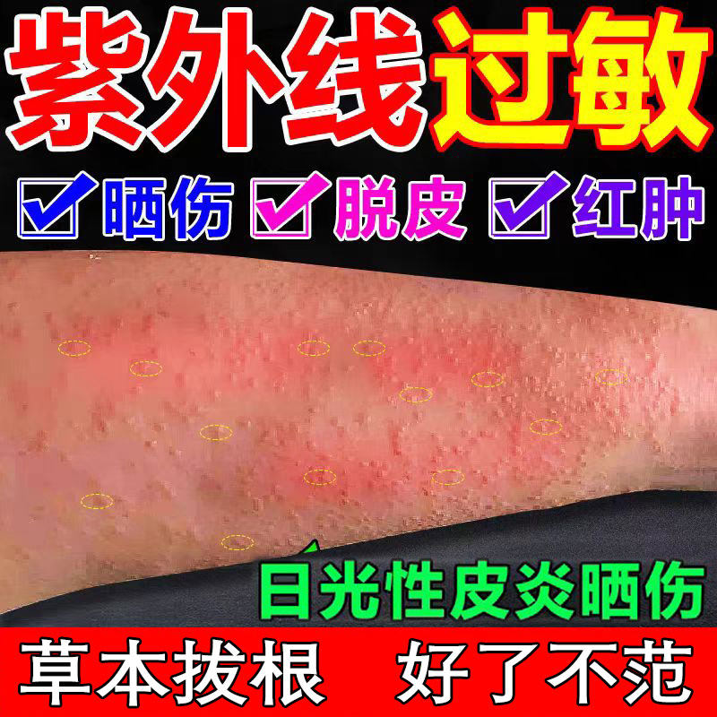 治日光性皮炎紫外线过敏修复霜专用膏药太阳晒伤神经性炎止痒特效