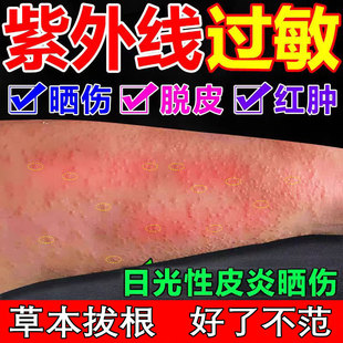 治日光性皮炎紫外线过敏修复霜专用膏药太阳晒伤神经性炎止痒特效