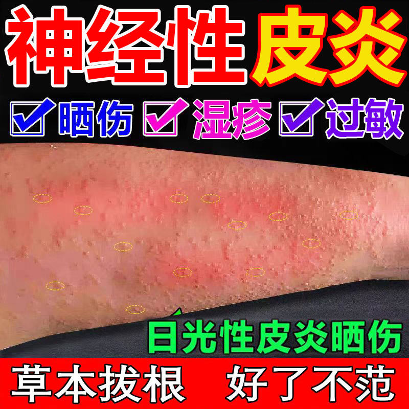 治疗顽固神经性皮炎特效外用膏药无激素去祛皮肤瘙痒疹根过敏除湿