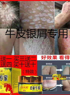 脚气牛皮手足藓 皮肤痒