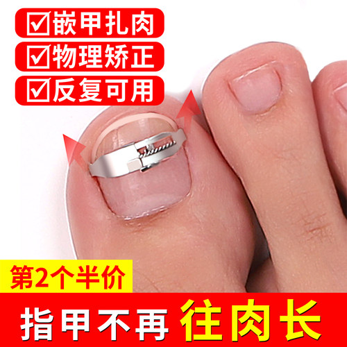 甲沟矫正器正甲扣嵌甲脚趾盖纠正