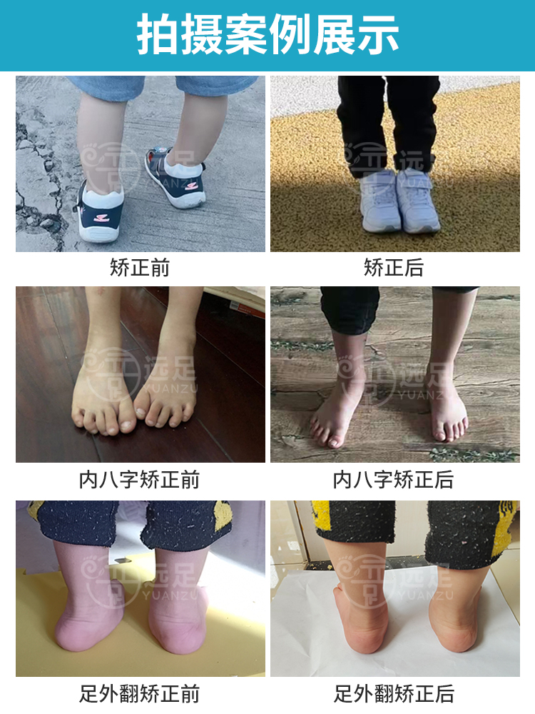 远足定制新品儿童内八字矫正鞋扁平足脚外翻马蹄内翻长短腿矫正鞋