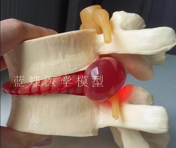 lumbar disc herniation human anatomy skeleton spine model te