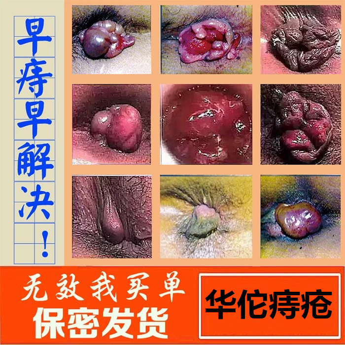 华佗治疗痔疮膏消肉球男女内痔外痔肛裂便血混合痔根断痣疮栓药膏|msdalam kategori Penyetempatan perkhidmatan kehidupan, Perkhidmatan kesihatan, 健康服务, 在线问诊, 内容分答 - dari Buy2taobao.com untuk memberikan perkhidmatan ejen Taobao profesional membeli