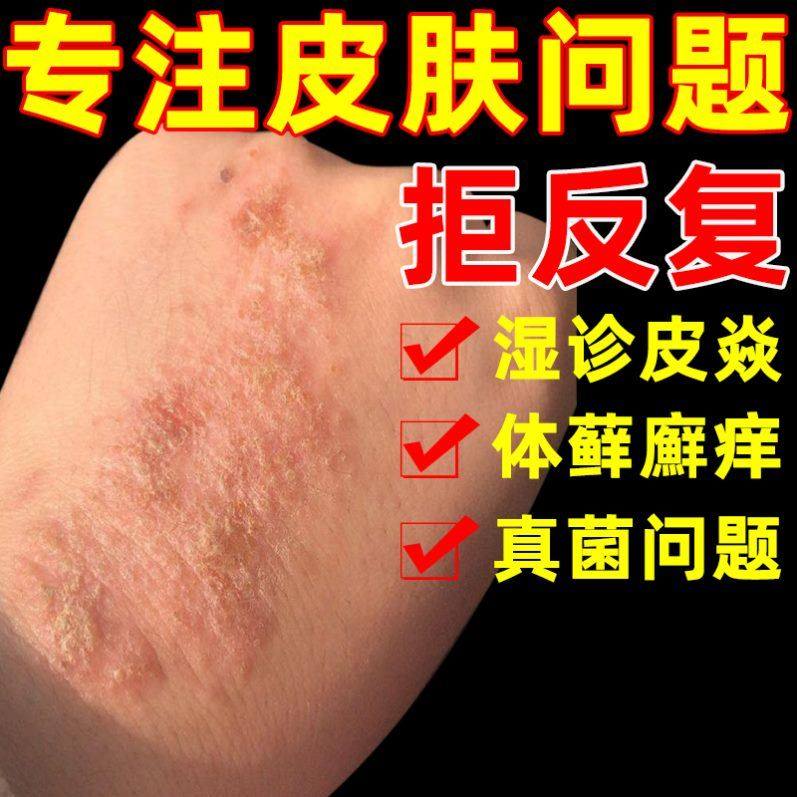 止痒治疗干疮的药治手裂的药膏干裂粗糙脱皮手脱皮药膏苗肤康药膏