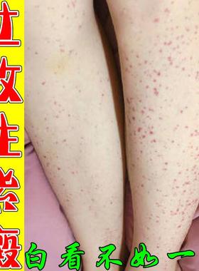 过敏性紫癜皮下出血腿上出现红色瘀滞色素性紫癜血管炎皮肤瘙痒药