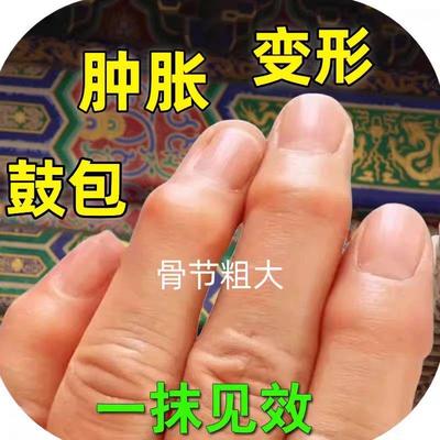 类风湿性关节炎手指关节变形肿大粗大神器僵硬增生疼痛酸麻专用药