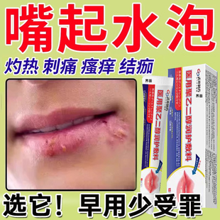 嘴唇单纯疱疹药膏口唇嘴巴上火起泡烂嘴角水泡开裂药口角炎病毒UU