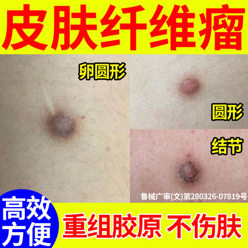 皮肤纤维瘤去除药膏硬块疙瘩结节皮下肿硬块脂肪瘤去除神器医用YB