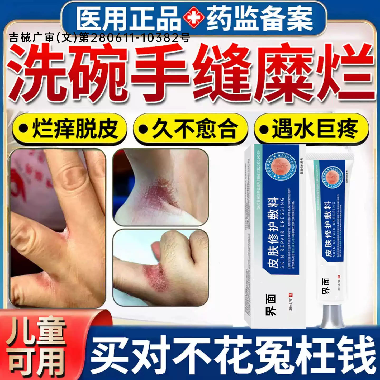 洗碗碰水手指缝溃烂药膏烂手丫脱皮干裂真菌感染湿疹止I痒去I根XY