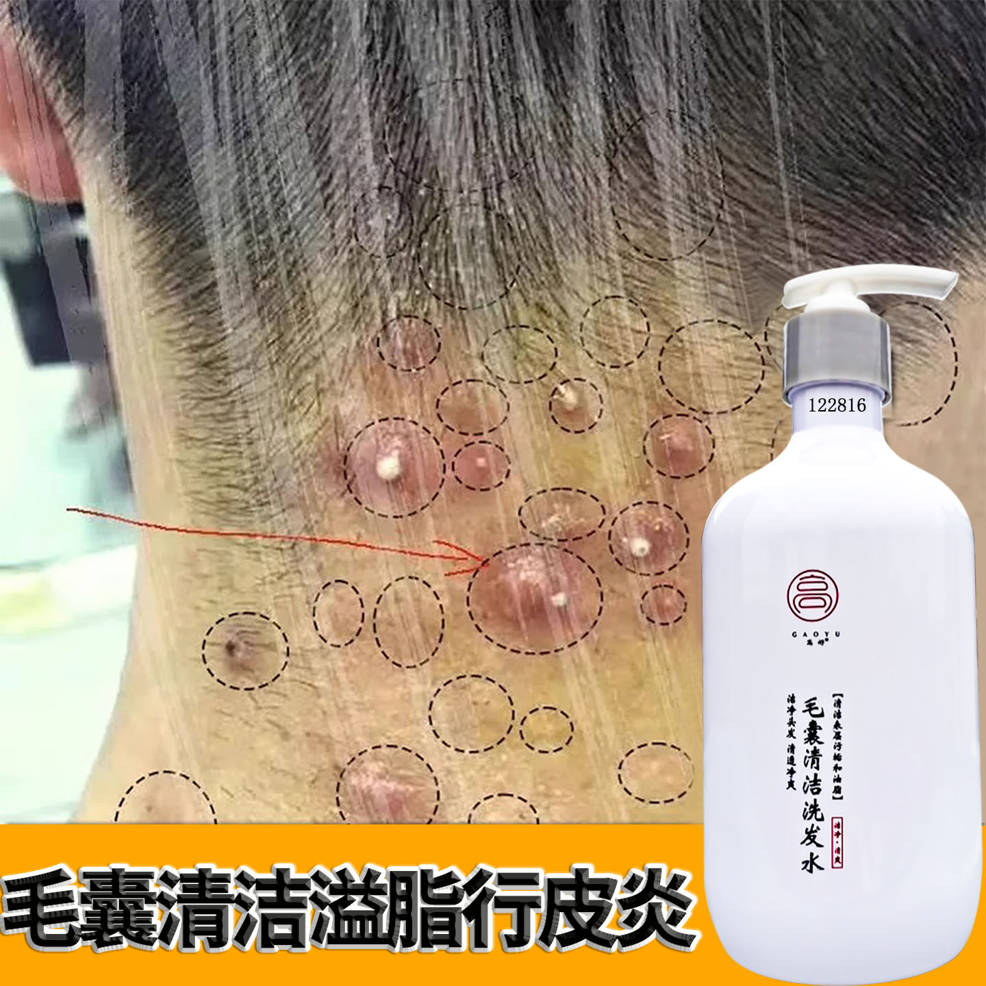 毛囊洗发头皮损伤修复祛痘除螨