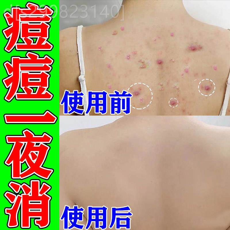 背上长痘痘后背长痱子除螨虫湿疹药膏脸上脖子修复淡化祛痘印神器