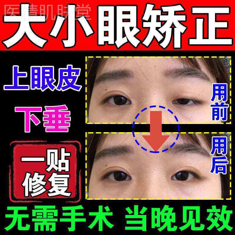 大小眼矫正器改善上眼皮下垂提拉贴老人双眼皮提拉紧致防松弛神器