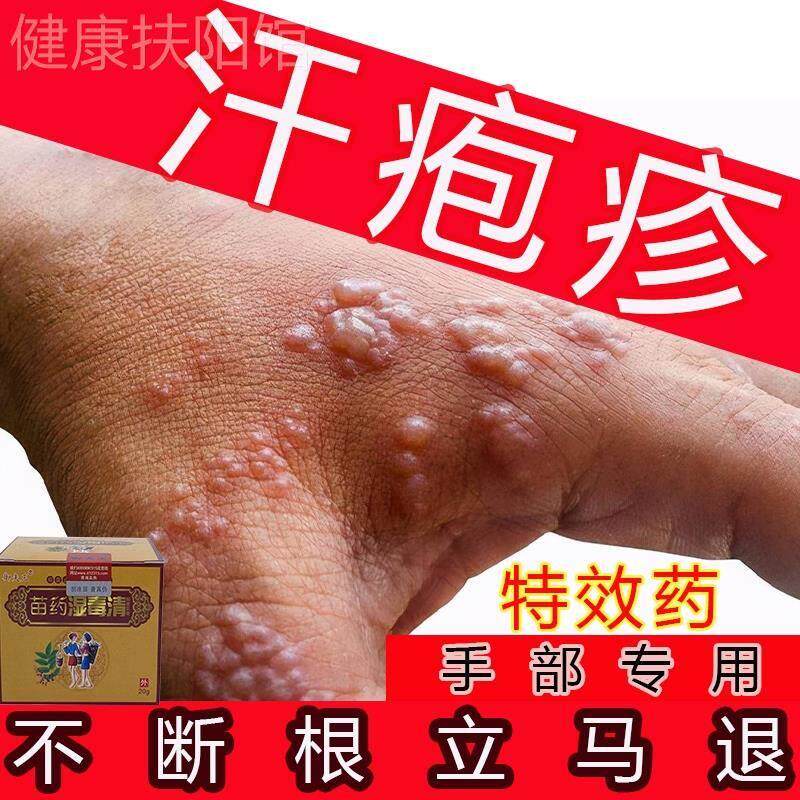 汗状疱疹专用软膏手足手部治疗脱皮干燥起泡去手气膏真菌感染杀菌