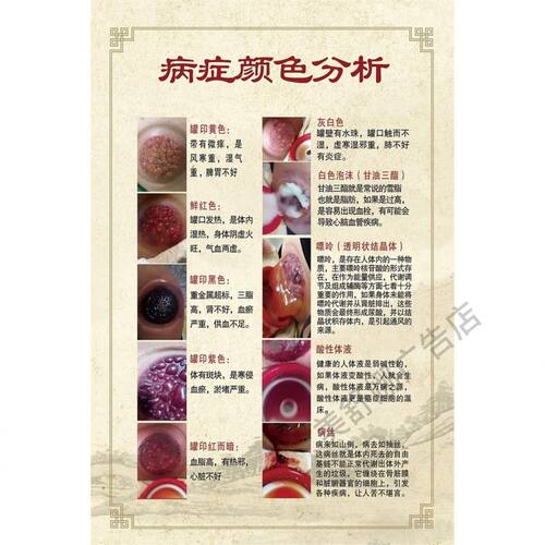拔罐海报罐印对应症状推拿店挂画理疗馆装饰画刮痧图片艾灸广告图
