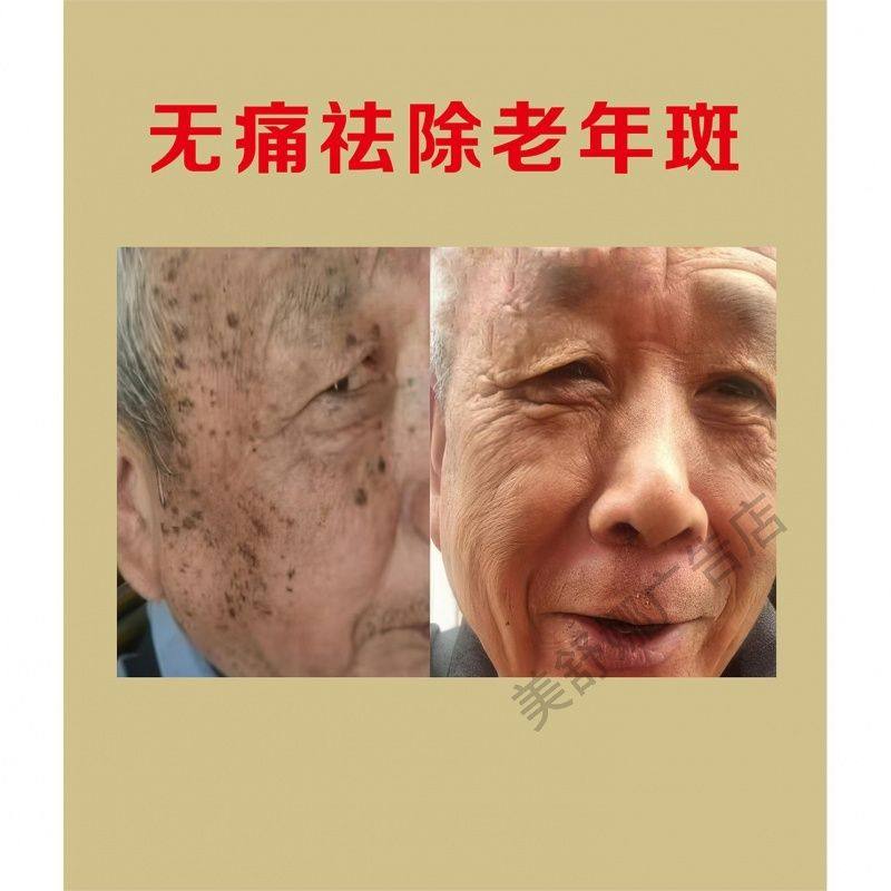 老年斑类型海报贴画宣传广告画定制祛斑类型分类症状高清贴墙挂画