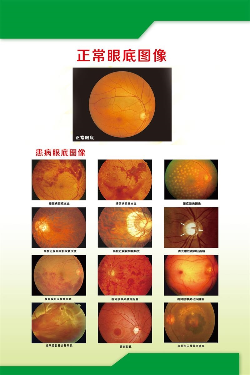 正常眼底图像海报展板诊疗知识青光眼眼部常见的健康问题挂图