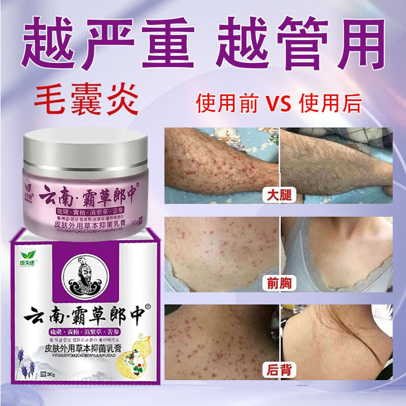 背胸部后脑勺毛囊炎真菌感染祛痘痘马拉色菌脂溢性皮炎止痒中药膏