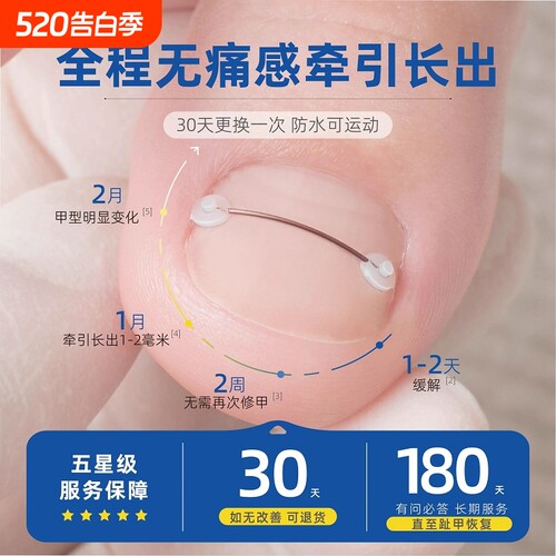 指甲矫正套装|超1000次加购