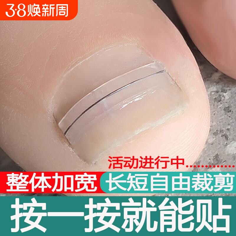 甲沟嵌甲矫正器正甲贴片镍钛合金仿生骨贴脚趾甲指甲扎肉矫正工具