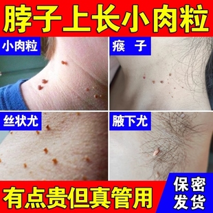 脖子上小肉球肉粒肉刺疙瘩贅肉絲狀疣瘊子去除神器腋下疣一抹無憂