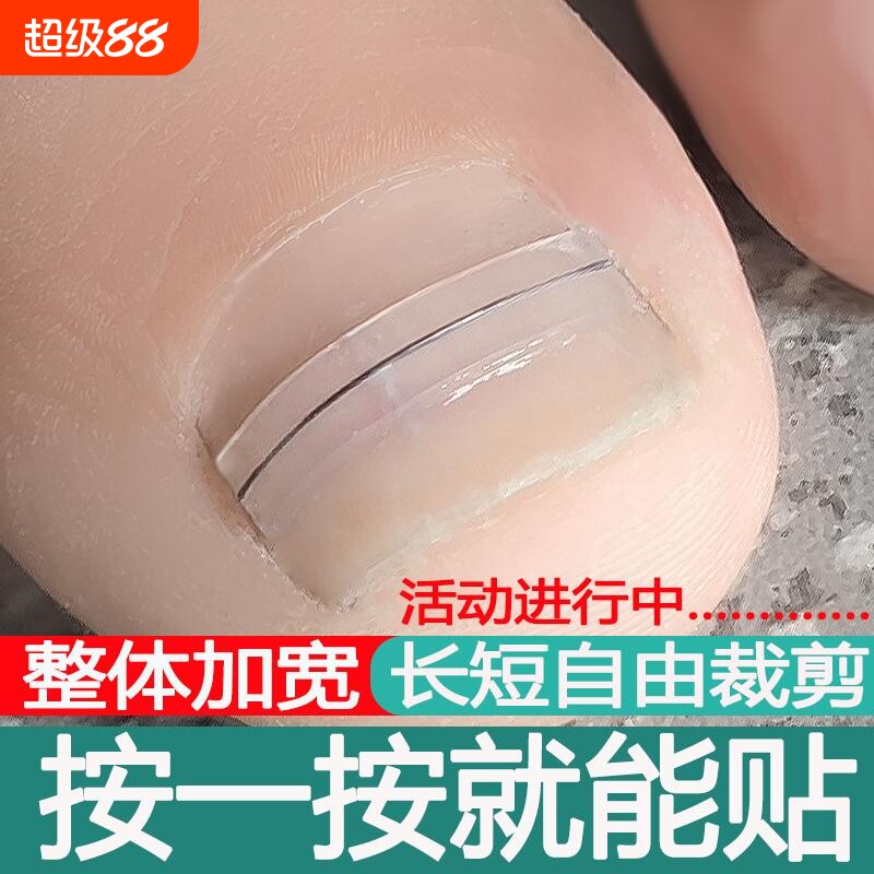 甲沟嵌甲矫正器正甲贴片镍钛合金仿生骨贴脚趾甲指甲扎肉矫正工具
